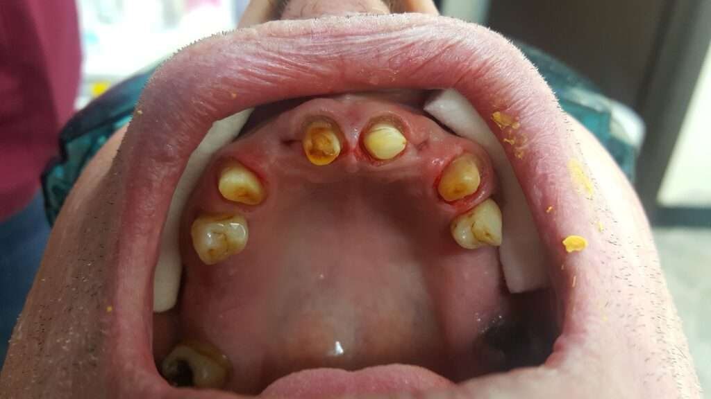 Prepared teeth with dental pegs