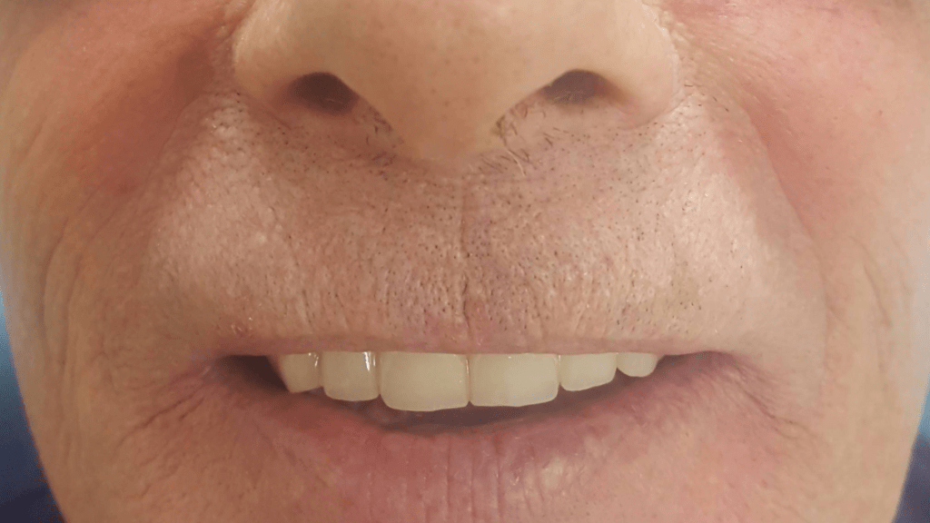 A much better smile!