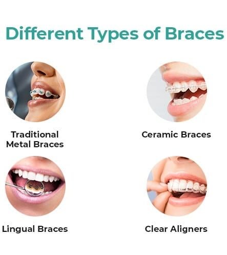 understanding-the-types-of-braces-which-option-is-right-for-you-2 Comparison of four orthodontic options: traditional metal braces, ceramic braces, lingual braces, and clear aligners