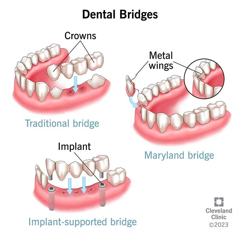 10921-dental-bridge Illustration comparing traditional, Maryland, and implant-supported dental bridges for replacing missing teeth