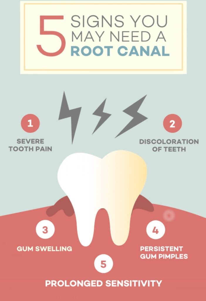 CREATOR: gd-jpeg v1.0 (using IJG JPEG v80), quality = 90 Infographic highlighting five signs you may need a root canal, including severe pain, discoloration, gum swelling, persistent gum pimples, and prolonged sensitivity.
