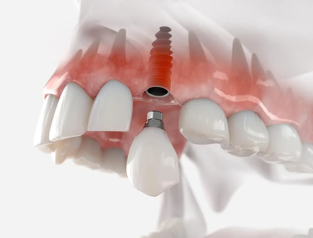 loose dental implant image by The Dentist West Midlands