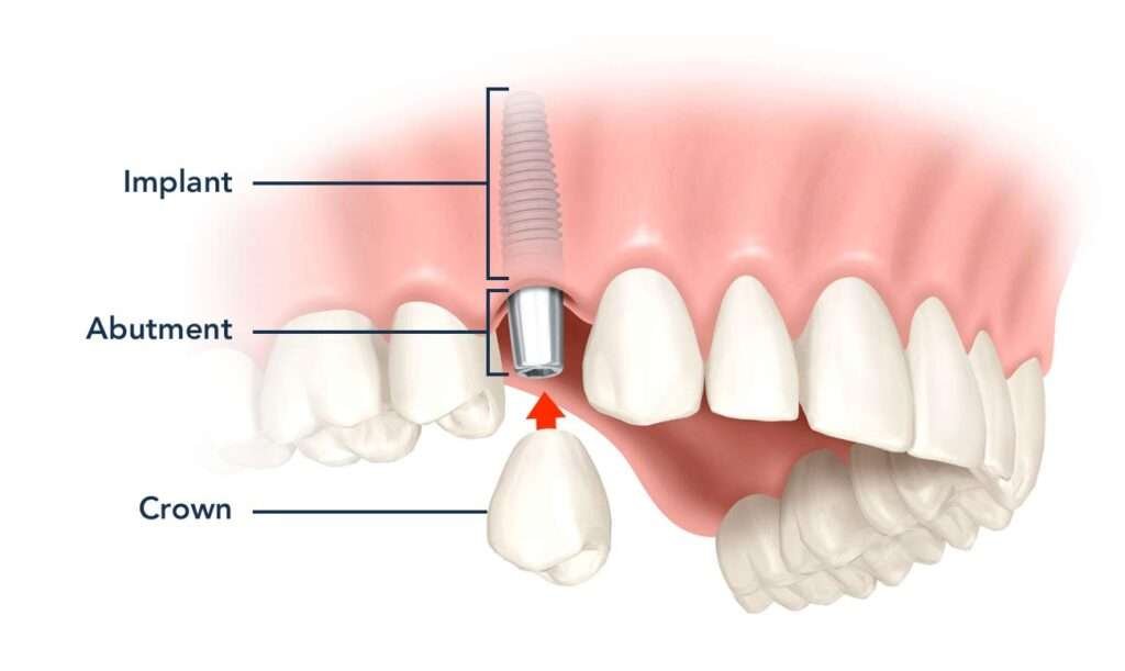 dental-implants-diagram