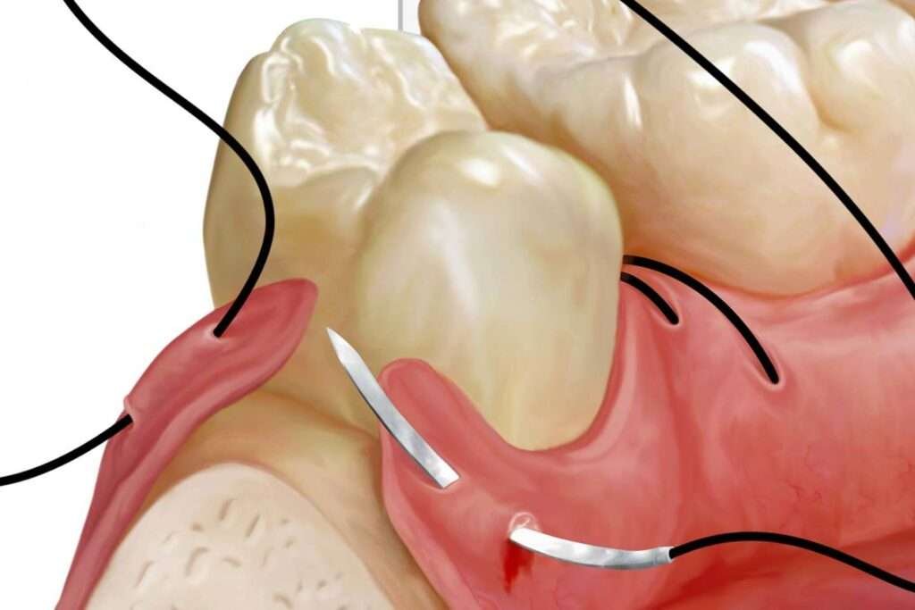 dental-sütür-malzemeleri-suture-ağız-ve-diş-sağlığı-dikiş-ameliyat-ipliği-surgery-çene-cerrahisi why are dental stitches used
