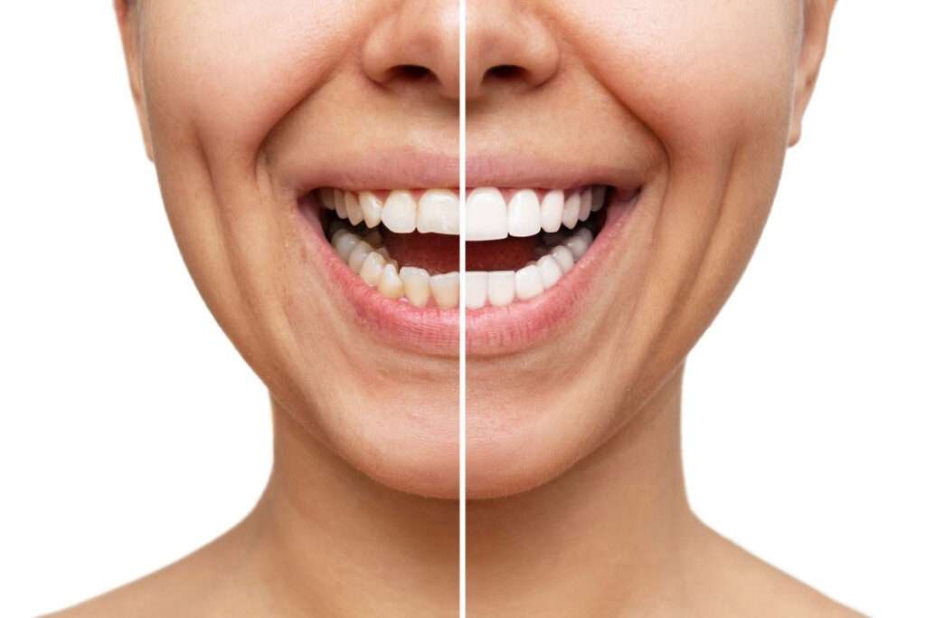 how-much-are-porcelain-veneers