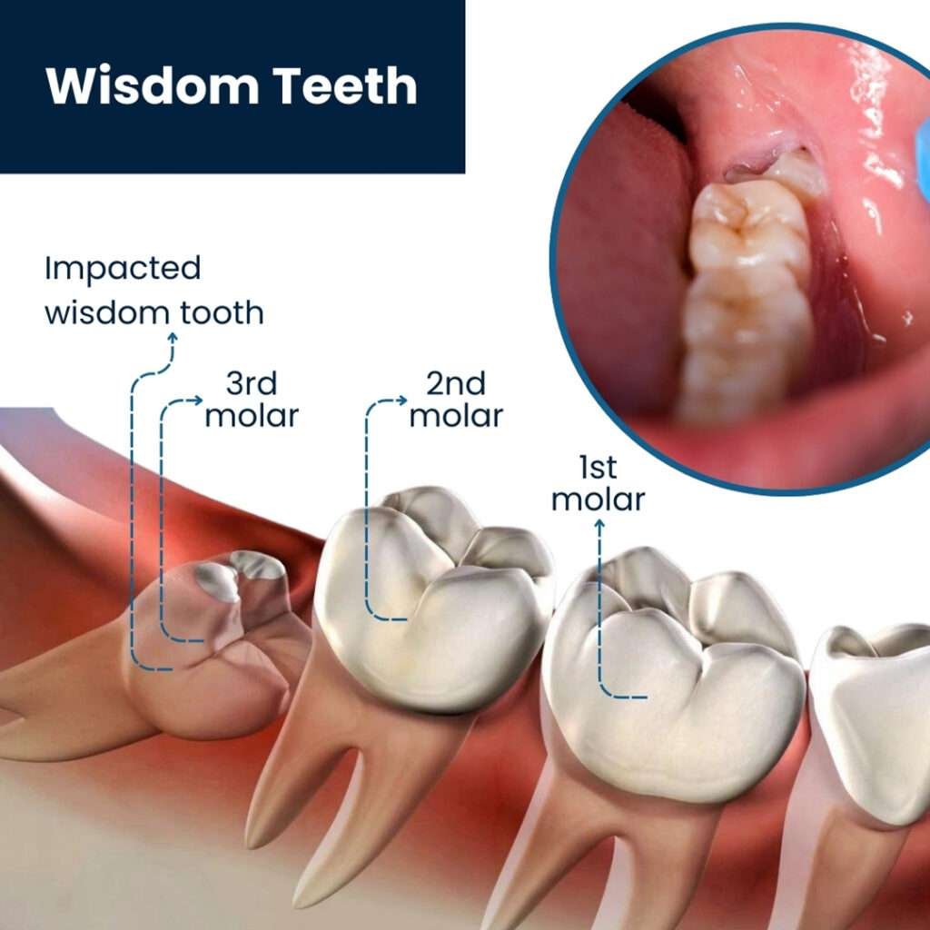 wisdom-tooth