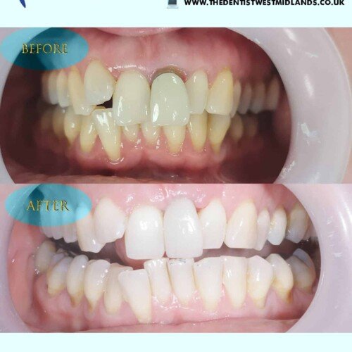 Front Tooth Implant & Cleaning | Before & After | The Dentist West Midlands.