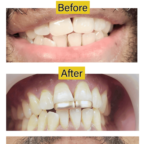 Cosmetic Dentistry | Before & After | The Dentist West Midlands