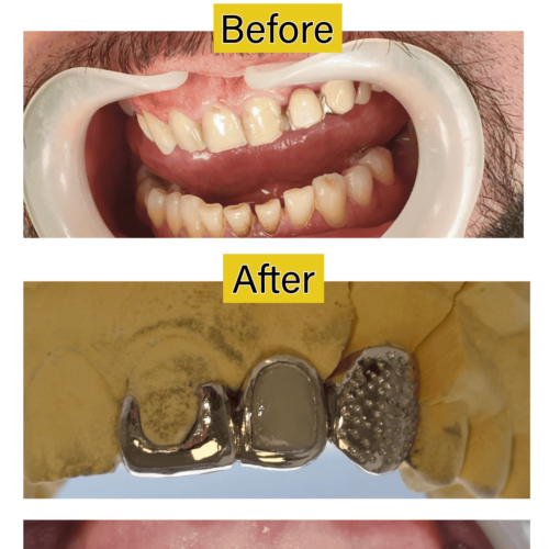 Restorative Dentistry | Before & After | The Dentist West Midlands