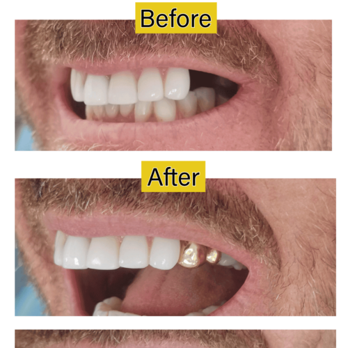 Gold Tooth Restoration | Before & After | The Dentist West Midlands