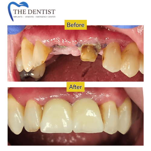 Full Mouth Reconstruction – Dental Implants and Crowns for a Complete Smile Makeover | The Dentist West Midlands.