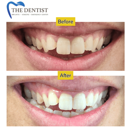 Transform Your Smile with Expert Cosmetic Dentistry – Teeth Whitening, Veneers & Orthodontics at The Dentist West Midlands