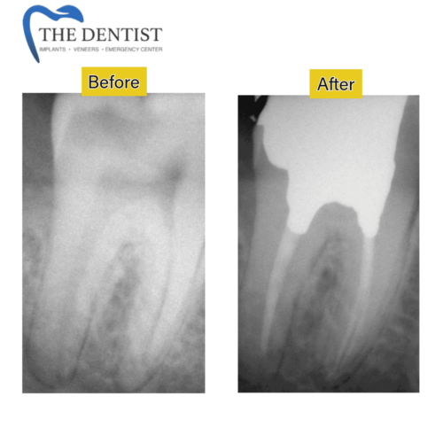 Root Canal Treatment – Expert Endodontic Care to Save and Restore Your Natural Tooth | The Dentist West Midlands