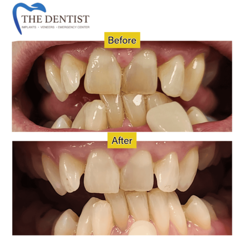 Teeth Straightening & Alignment Correction – Achieve a Healthier, More Confident Smile at The Dentist West Midlands