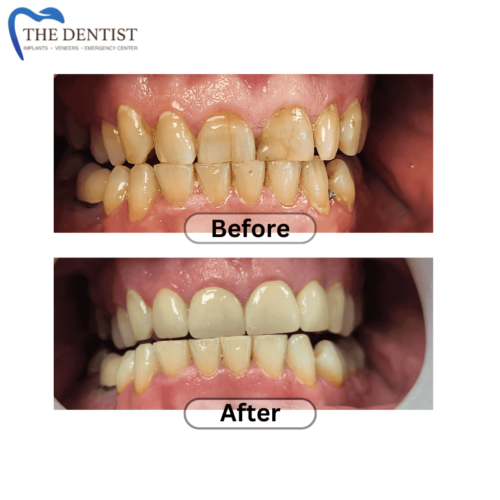 Before-and-after images showing a dramatic improvement in tooth color following a teeth whitening treatment