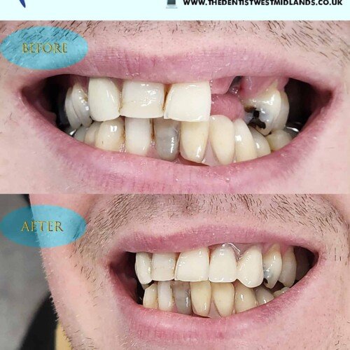 Immediate Tooth Extraction & Denture Replacement | The Dentist West Midlands