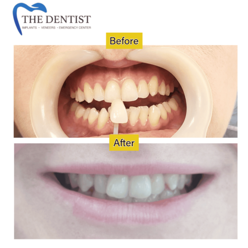 Before-and-after images showcasing straighter teeth following orthodontic treatment