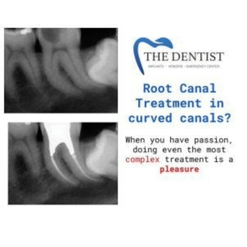 Endodontic treatment for complex curved root canals – before and after
