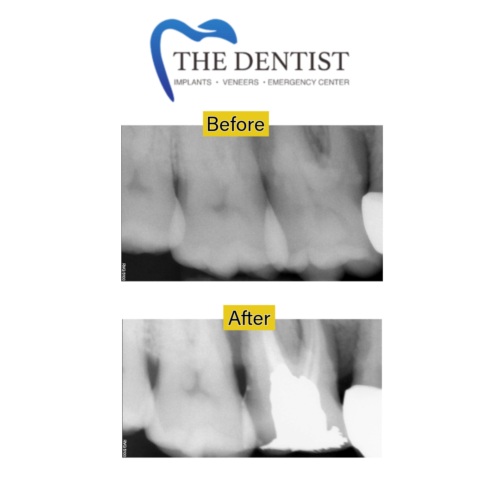 root-canal