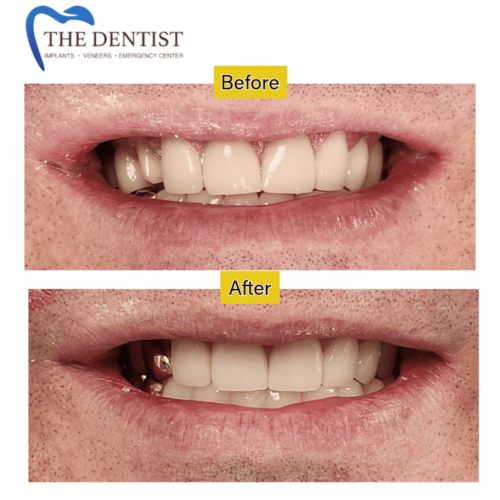 Cosmetic dentistry with gold crowns – before and after results