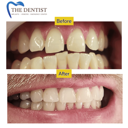 Before and after dental restoration – improved smile