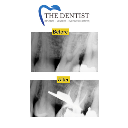 root-canal