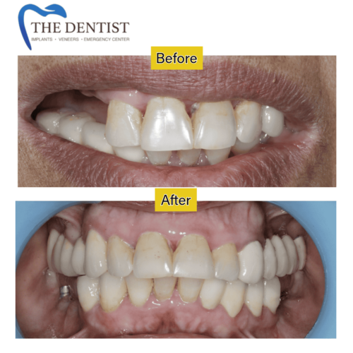 Before and after full-mouth dental implant restoration – improved smile and function by The Dentist West Midlands