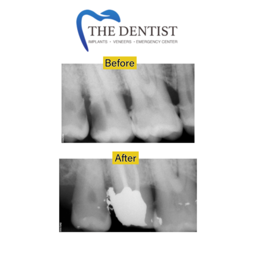 root-canal