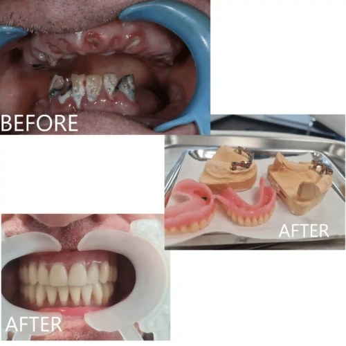 full arch implant supported denture